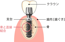 第三の歯一インプラント（入工歯根）