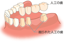 人工の歯