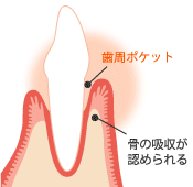 歯周病は、おもに歯肉が歯に接する付近に存在する歯垢中の細菌が原因で進行します。